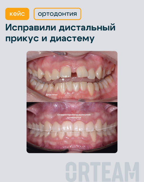 Диастема или щербинка. Что это, почему возникает, как убрать и можно ли оставить?