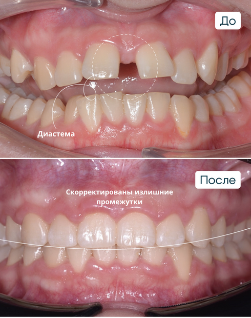 Диастема или щербинка. Что это, почему возникает, как убрать и можно ли оставить?