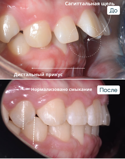 Диастема или щербинка. Что это, почему возникает, как убрать и можно ли оставить?