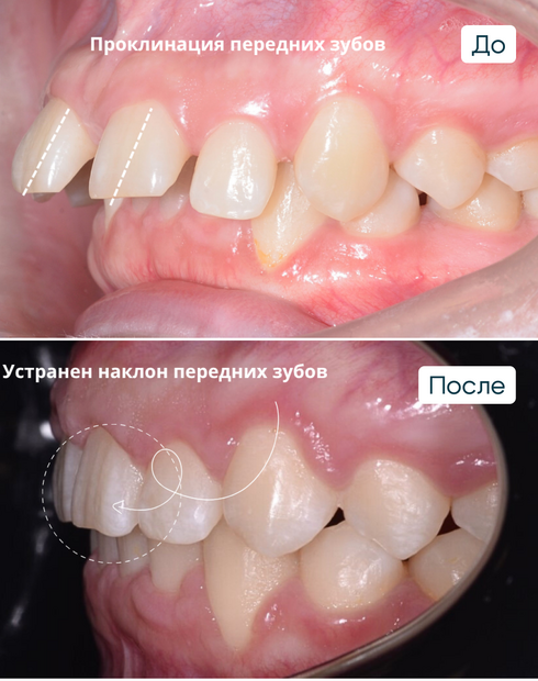 Диастема или щербинка. Что это, почему возникает, как убрать и можно ли оставить?