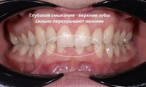 Ортодонтическая подготовка к имплантации при дистальном глубоком прикусе