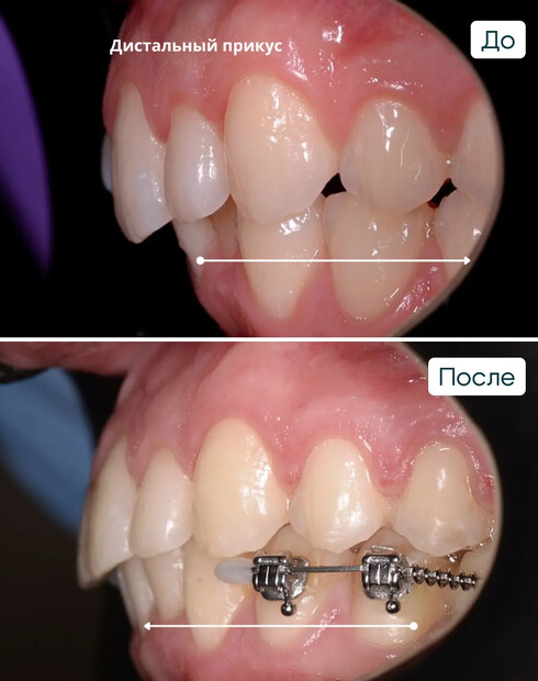 Ортодонтическая подготовка к имплантации при дистальном глубоком прикусе