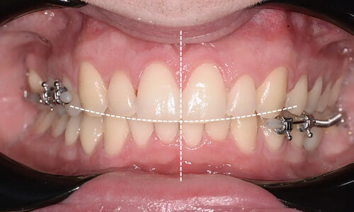 Ортодонтическая подготовка к имплантации при дистальном глубоком прикусе