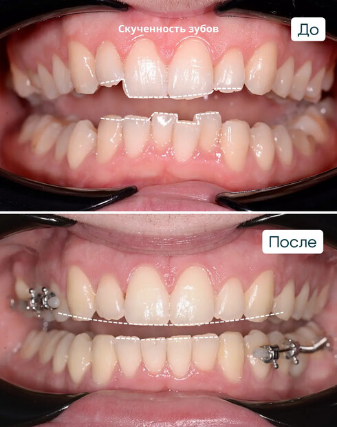 Ортодонтическая подготовка к имплантации при дистальном глубоком прикусе
