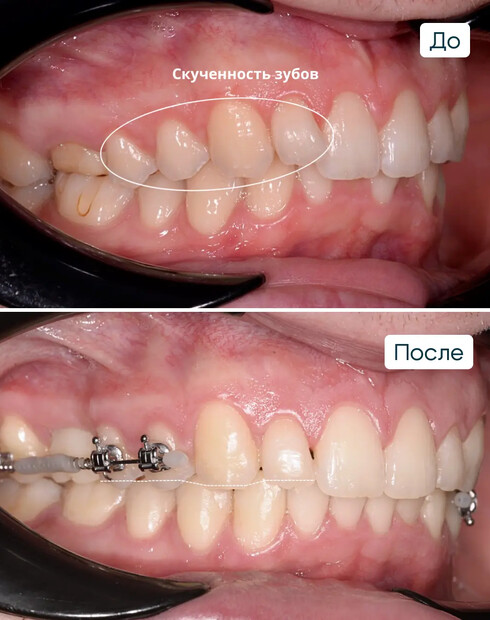 Ортодонтическая подготовка к имплантации при дистальном глубоком прикусе