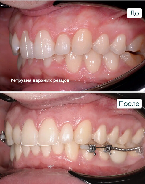 Ортодонтическая подготовка к имплантации при дистальном глубоком прикусе