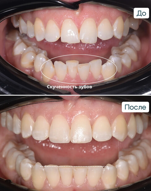 Ортодонтическое закрытие промежутка и создание пространства под имплантацию