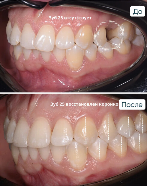 Ортодонтическое закрытие промежутка и создание пространства под имплантацию