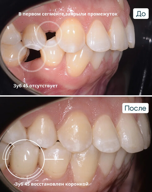 Ортодонтическое закрытие промежутка и создание пространства под имплантацию