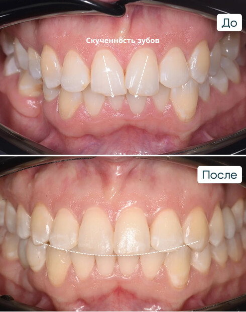 Ортодонтическое закрытие промежутка и создание пространства под имплантацию