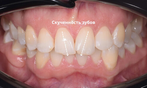 Ортодонтическое закрытие промежутка и создание пространства под имплантацию