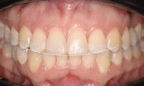 Ортодонтическое закрытие промежутка и создание пространства под имплантацию