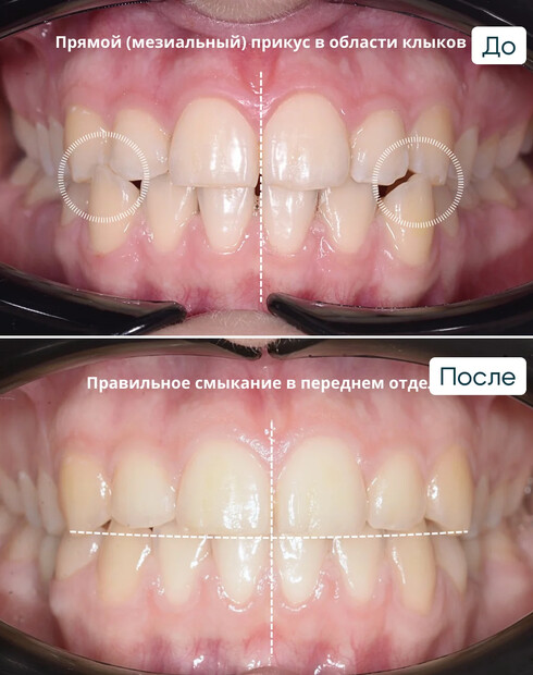 Имплантация нижних пятёрок на элайнерах - фото 1 до и после