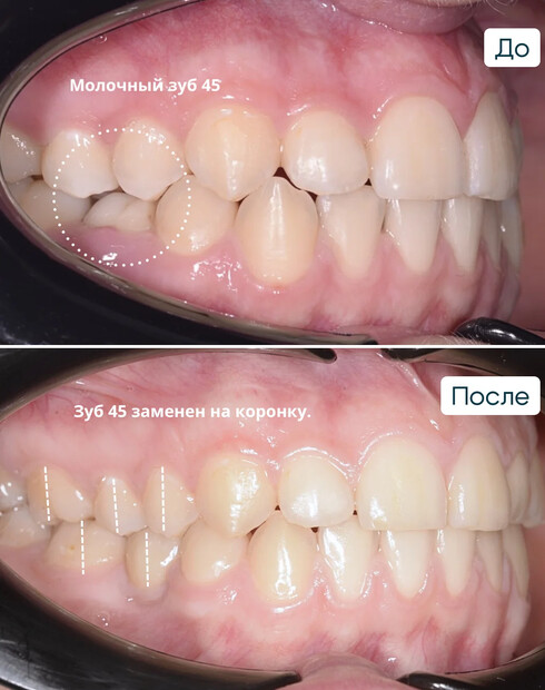 Имплантация нижних пятёрок на элайнерах - фото 2 до и после
