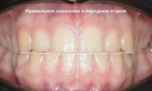Подготовка к имплантации нижних пятёрок на элайнерах
