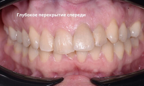 Ортодонтическая компенсация скелетного дистального прикуса без операции