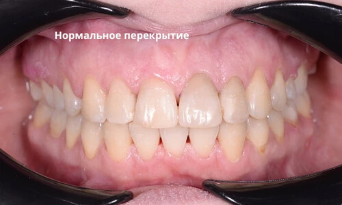 Ортодонтическая компенсация скелетного дистального прикуса без операции