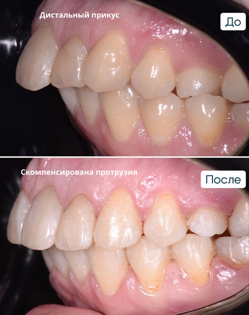 Ортодонтическая компенсация скелетного дистального прикуса без операции