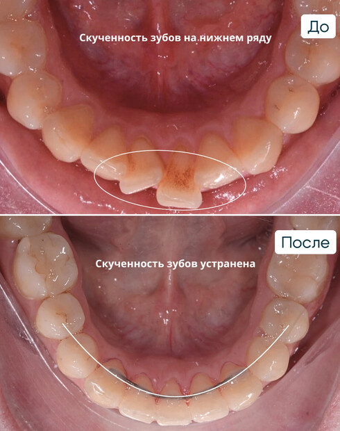 Ортодонтическая компенсация скелетного дистального прикуса без операции