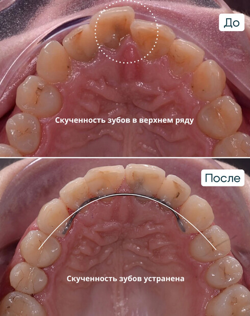 Ортодонтическая компенсация скелетного дистального прикуса без операции