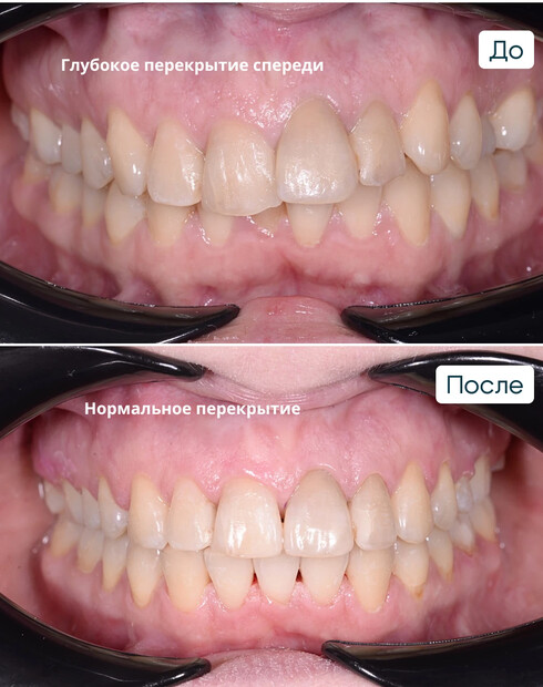 Ортодонтическая компенсация скелетного дистального прикуса без операции