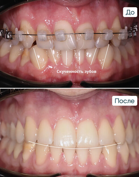 Ортодонтическая коррекция скученности зубов