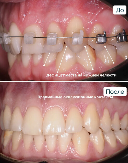 Ортодонтическая коррекция скученности зубов