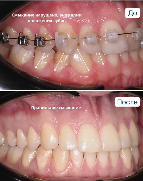 Ортодонтическая коррекция скученности зубов