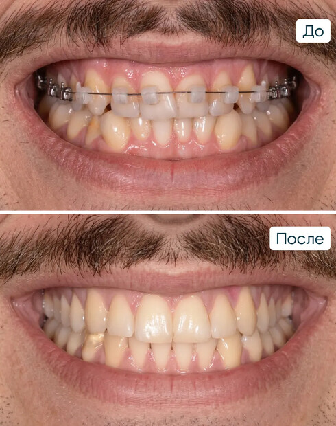 Ортодонтическая коррекция скученности зубов