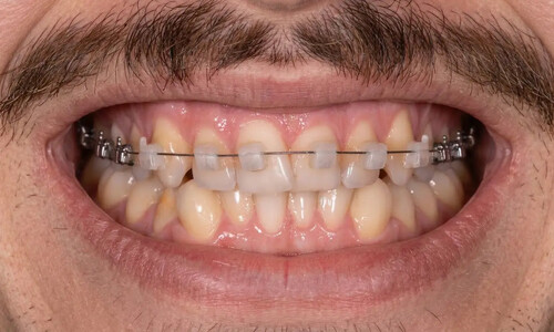 Ортодонтическая коррекция скученности зубов