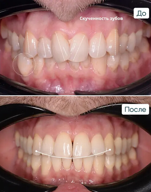 Исправление скученности зубов и перекрёстного прикуса на брекетах