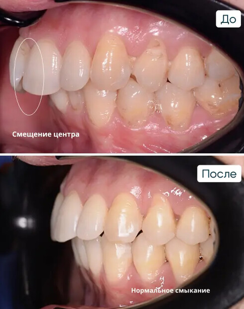 Исправление скученности зубов и перекрёстного прикуса на брекетах