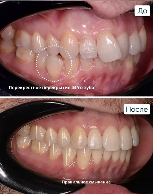 Исправление скученности зубов и перекрёстного прикуса на брекетах