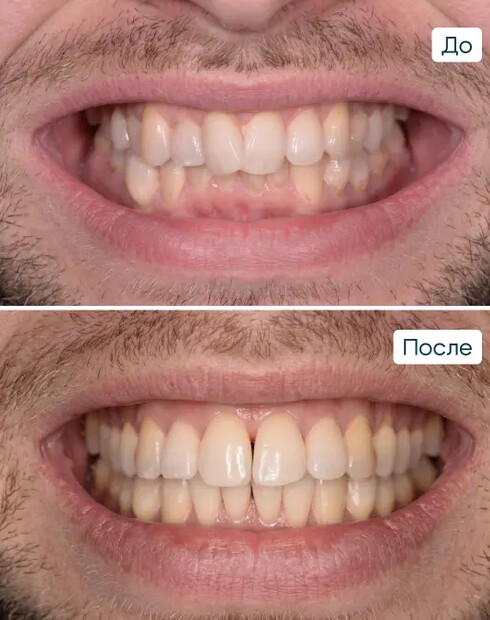 Исправление скученности зубов и перекрёстного прикуса на брекетах