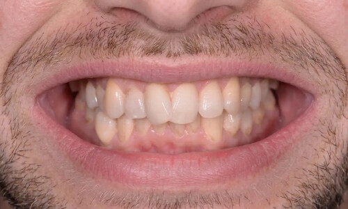 Исправление скученности зубов и перекрёстного прикуса на брекетах