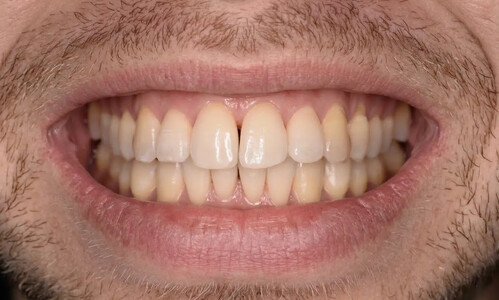 Исправление скученности зубов и перекрёстного прикуса на брекетах