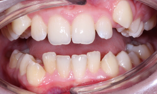 Коррекция скученности зубов - быстрое лечение - фото 1 до