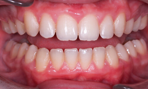 Коррекция выраженной скученности зубов у подростка