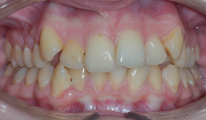 Коррекция скученности зубов - выраженный дефицит места - фото 1 до