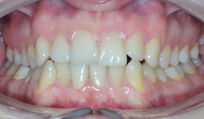 Исправление скученности зубов - лечение - фото 1 до