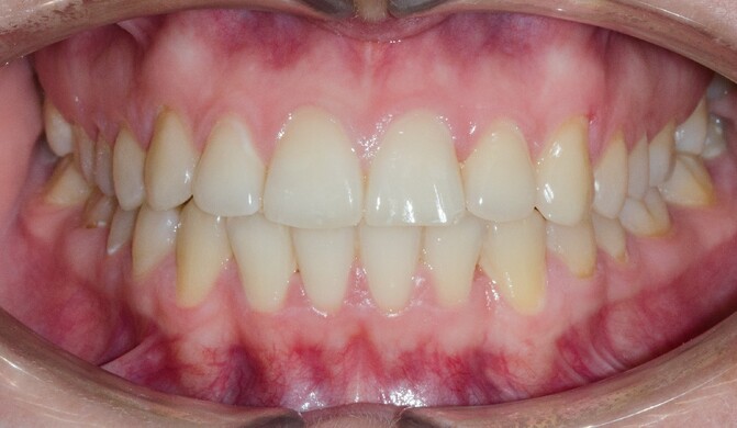 Исправление скученности зубов - лечение - фото 1 после