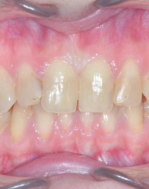 Какие бывают брекеты: виды, стоимость, плюсы и минусы