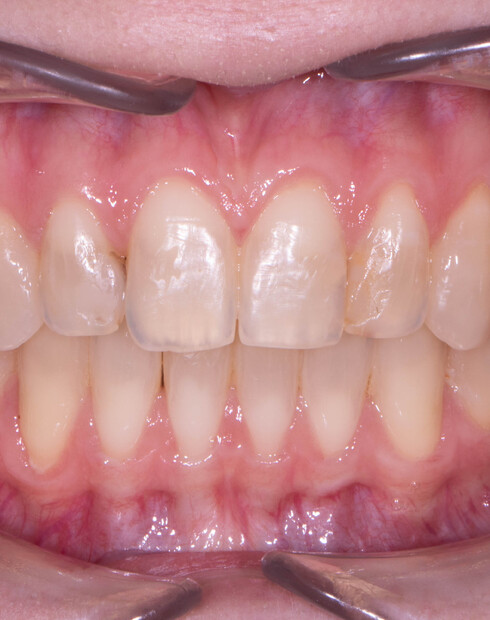 Какие бывают брекеты: виды, стоимость, плюсы и минусы