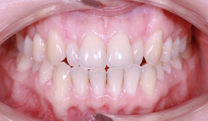 Коррекция прямого резцового перекрытия - фото 1 до