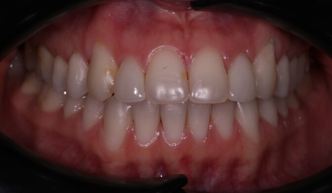 Коррекция прямого резцового перекрытия - фото 1 после