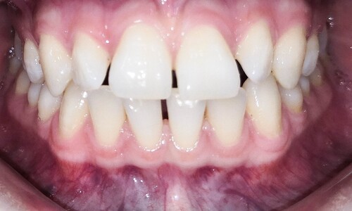 Коррекция избытка места на челюсти - фото 1 до