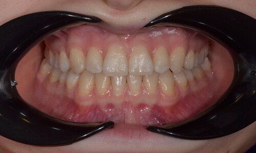 Коррекция избытка места на челюсти