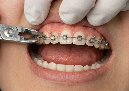 Снятие брекетов и ретенция, сколько носят, как происходит снятие