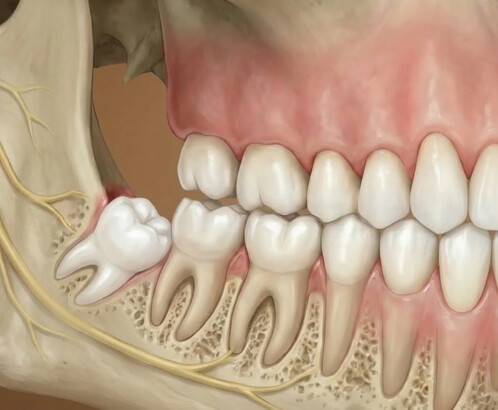 Почему зубы мудрости не прорезаются
