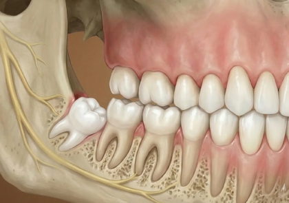 Почему зубы мудрости не прорезаются